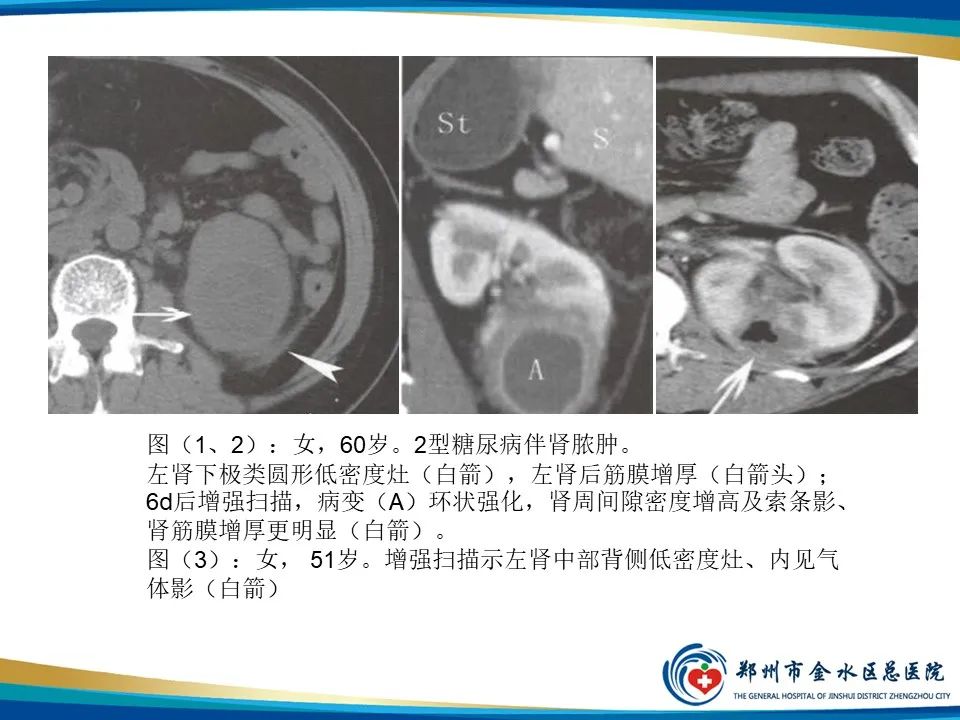 影像PPT - 【PPT】黄色肉芽肿性肾盂肾炎影像表现-34