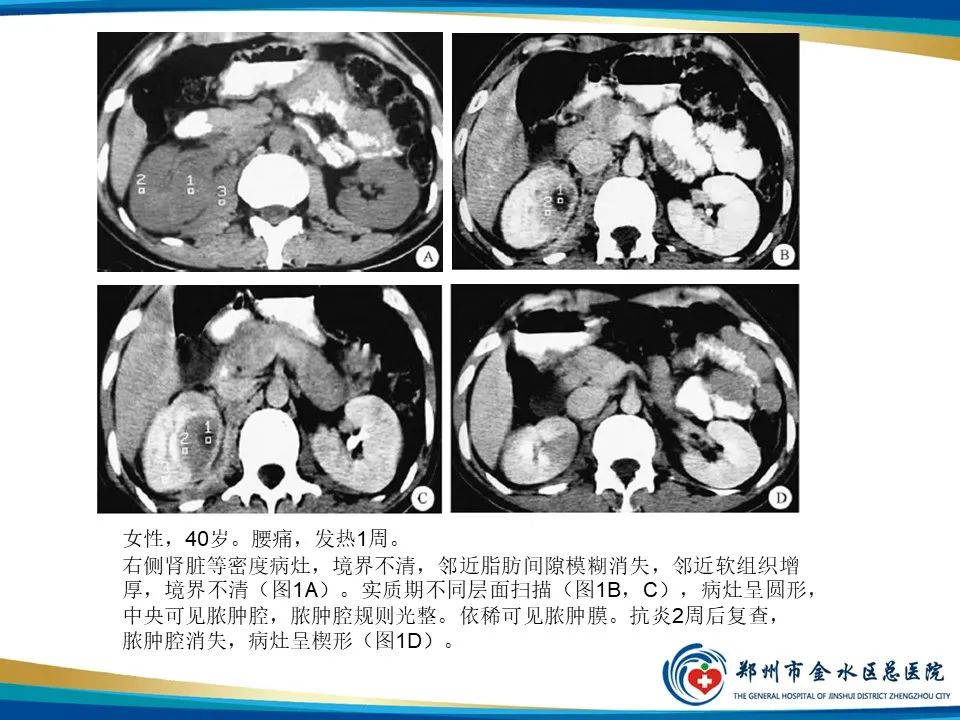 影像PPT - 【PPT】黄色肉芽肿性肾盂肾炎影像表现-35