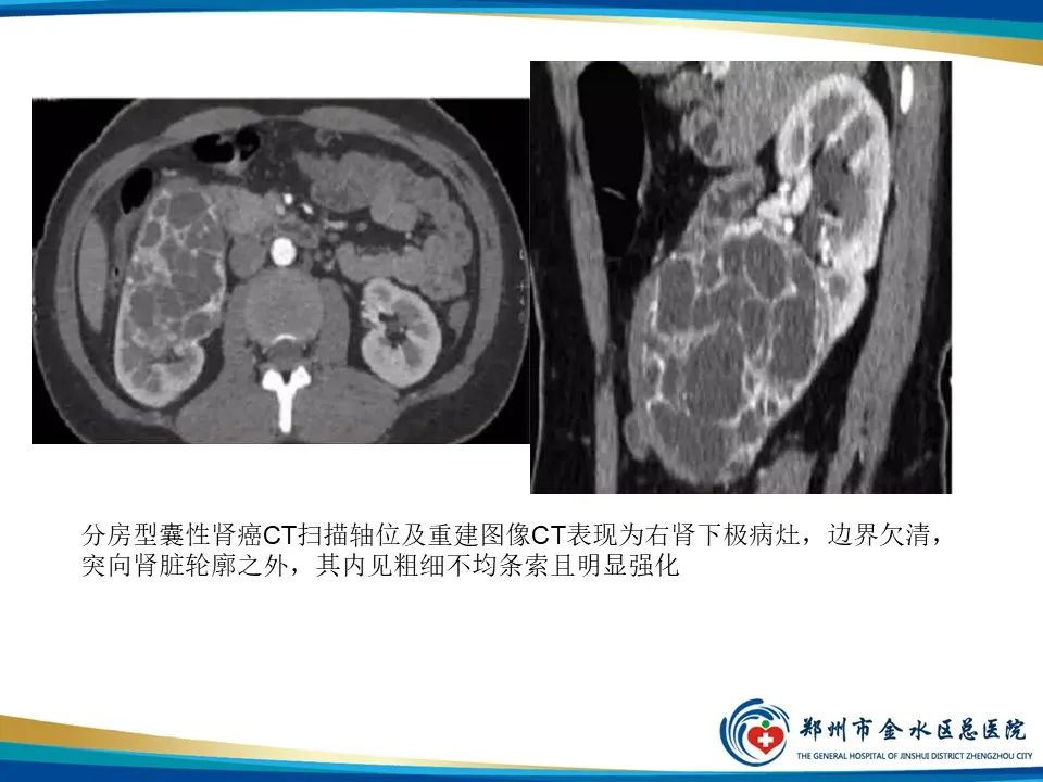 影像PPT - 【PPT】黄色肉芽肿性肾盂肾炎影像表现-38