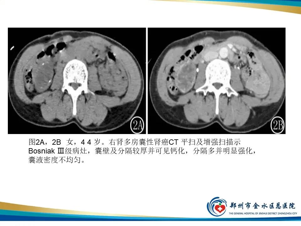 影像PPT - 【PPT】黄色肉芽肿性肾盂肾炎影像表现-39