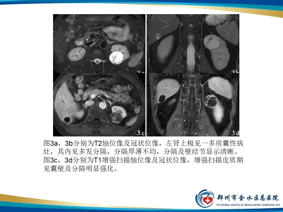 影像PPT - 【PPT】黄色肉芽肿性肾盂肾炎影像表现-40