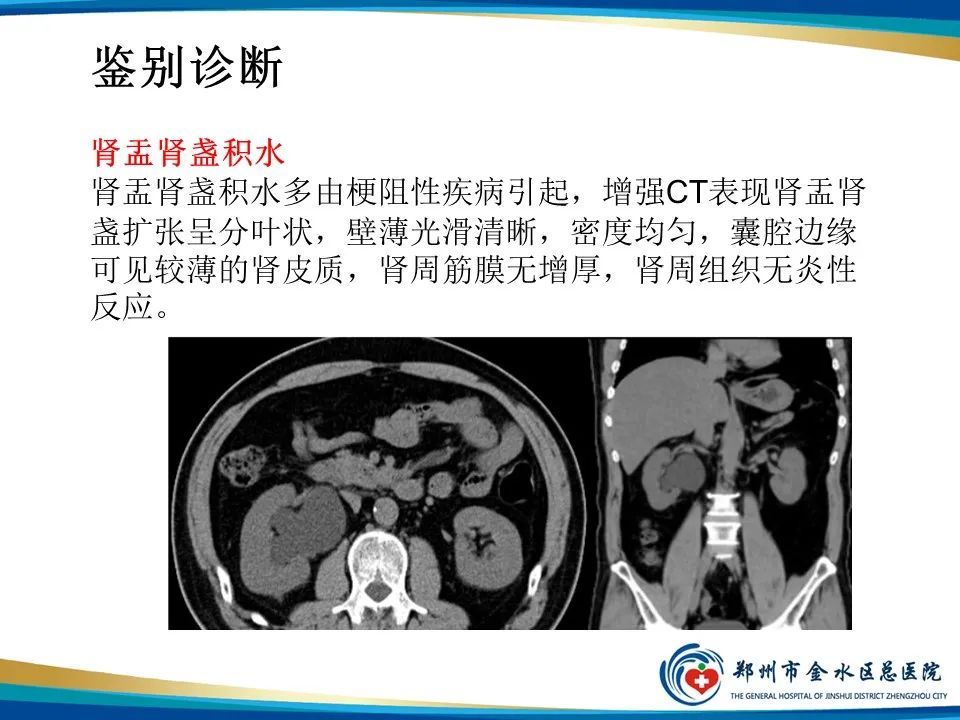 影像PPT - 【PPT】黄色肉芽肿性肾盂肾炎影像表现-41