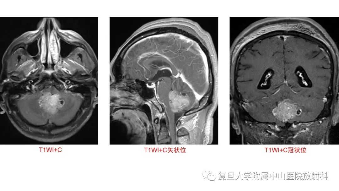 影像PPT - 【病例】成人四脑室髓母细胞瘤2例CT及MR-4