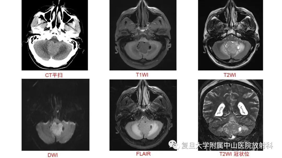 影像PPT - 【病例】成人四脑室髓母细胞瘤2例CT及MR-3
