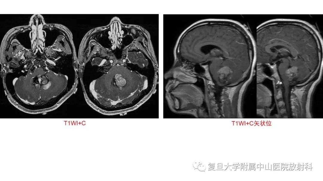 影像PPT - 【病例】成人四脑室髓母细胞瘤2例CT及MR-7