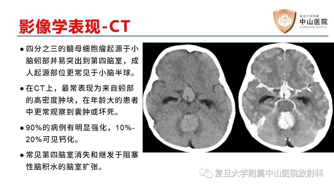 影像PPT - 【病例】成人四脑室髓母细胞瘤2例CT及MR-13