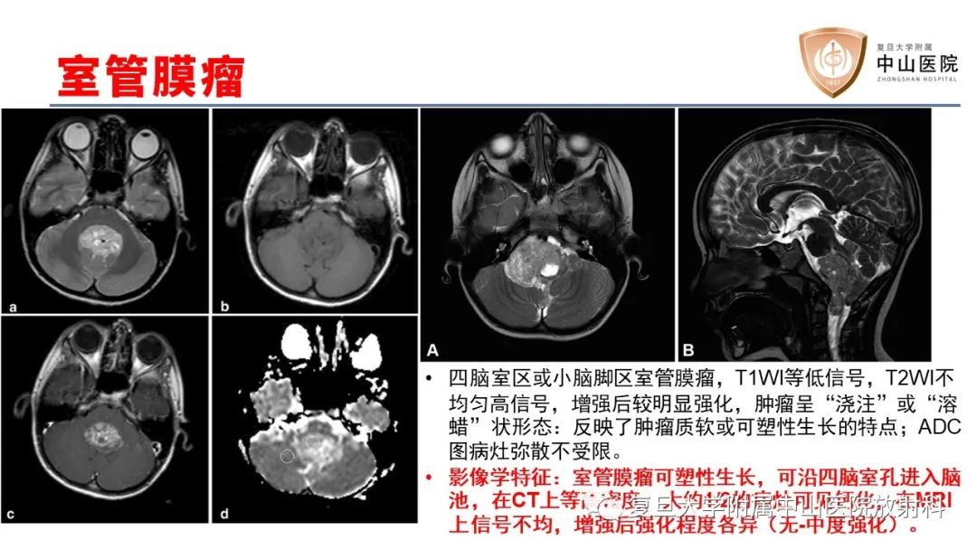 影像PPT - 【病例】成人四脑室髓母细胞瘤2例CT及MR-21