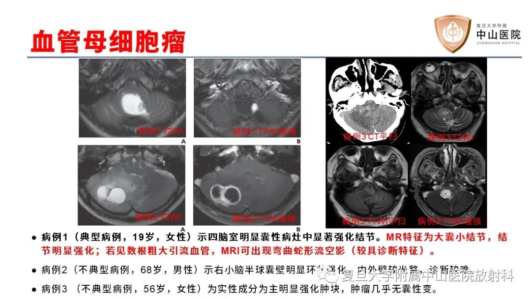 影像PPT - 【病例】成人四脑室髓母细胞瘤2例CT及MR-22