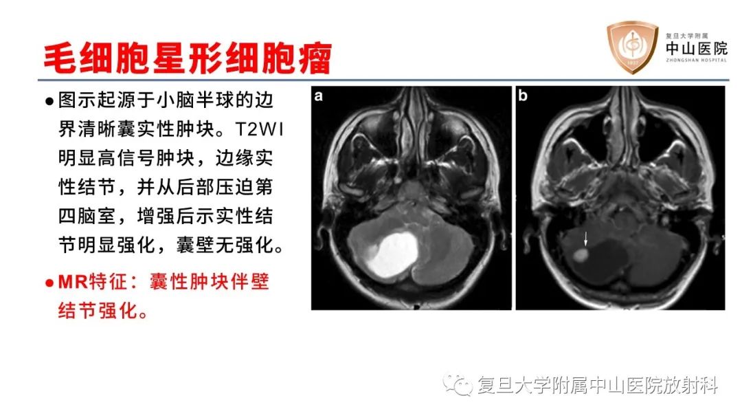影像PPT - 【病例】成人四脑室髓母细胞瘤2例CT及MR-23