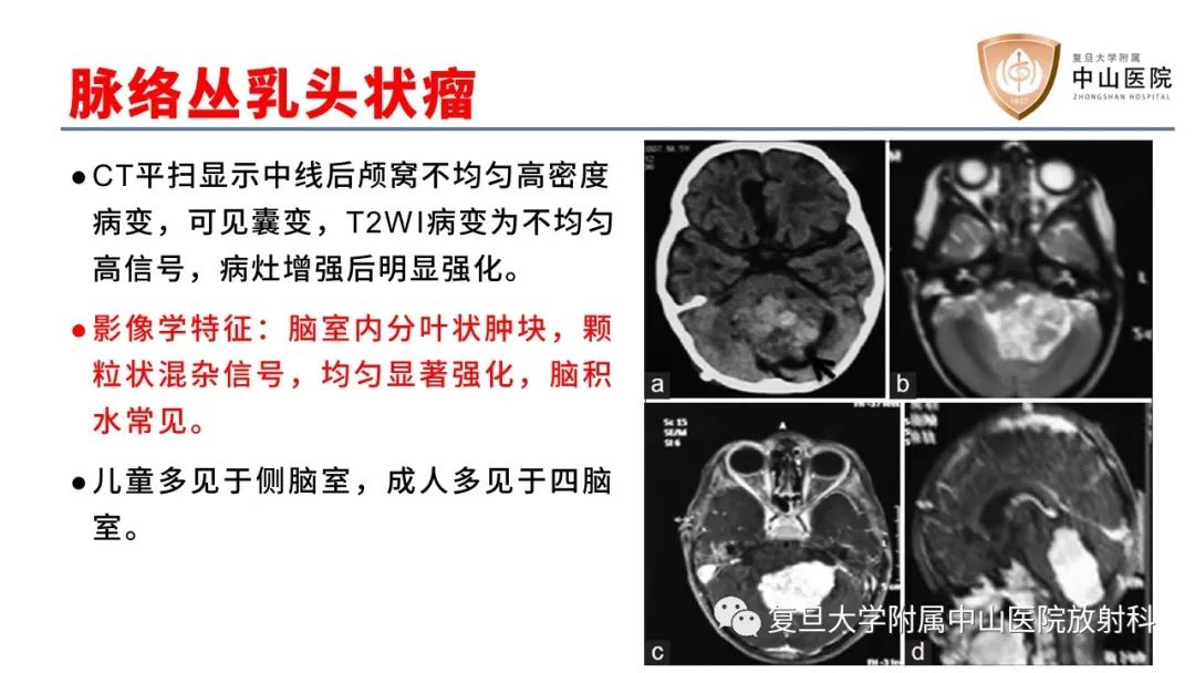 影像PPT - 【病例】成人四脑室髓母细胞瘤2例CT及MR-24