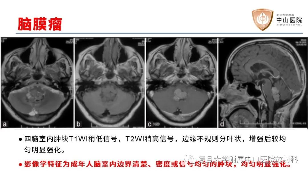 影像PPT - 【病例】成人四脑室髓母细胞瘤2例CT及MR-25