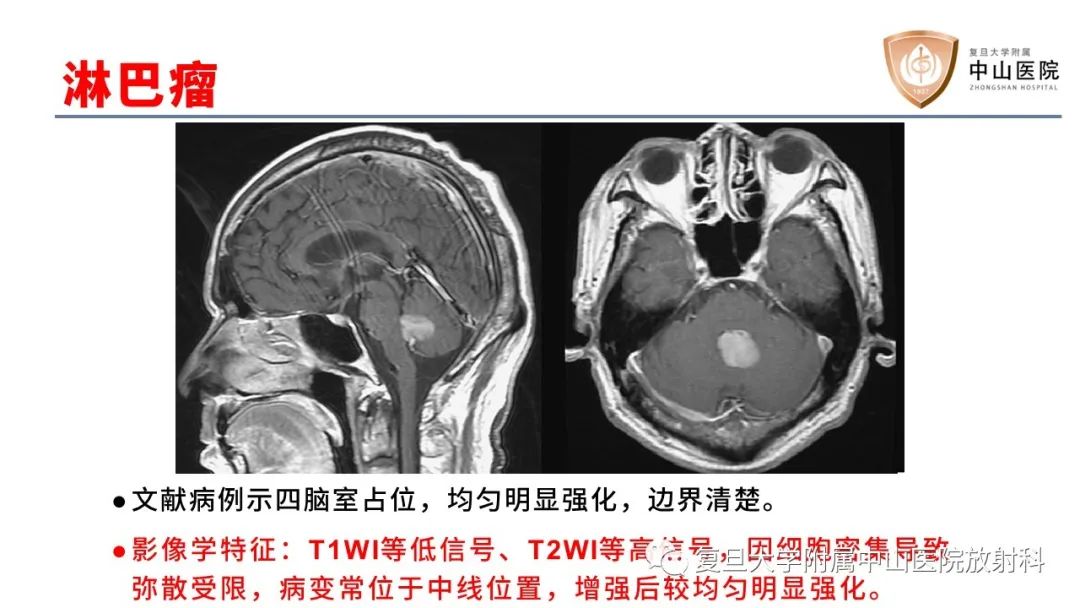 影像PPT - 【病例】成人四脑室髓母细胞瘤2例CT及MR-26