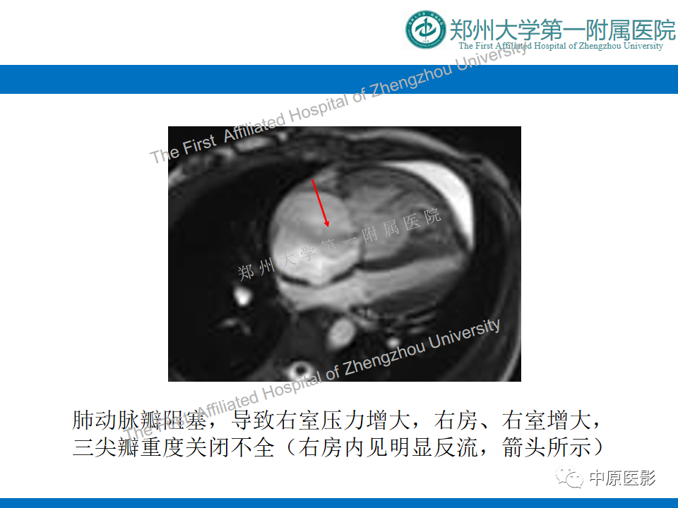 影像PPT - 【病例】心脏血管瘤1例MR影像-5