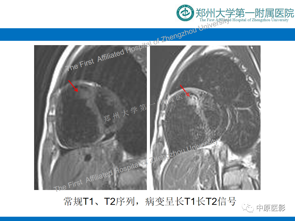影像PPT - 【病例】心脏血管瘤1例MR影像-4