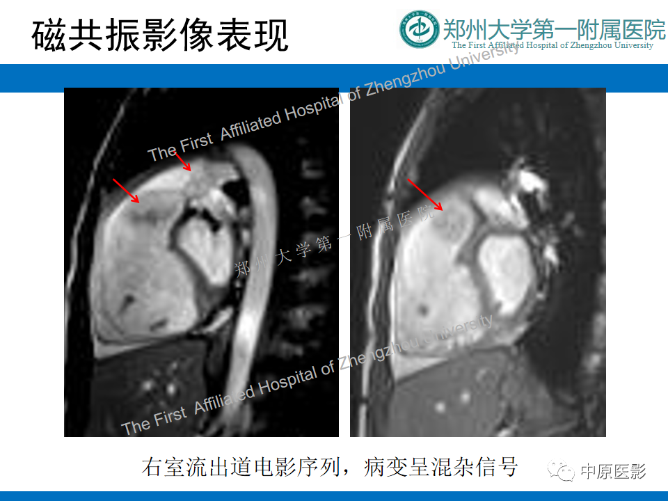 影像PPT - 【病例】心脏血管瘤1例MR影像-3
