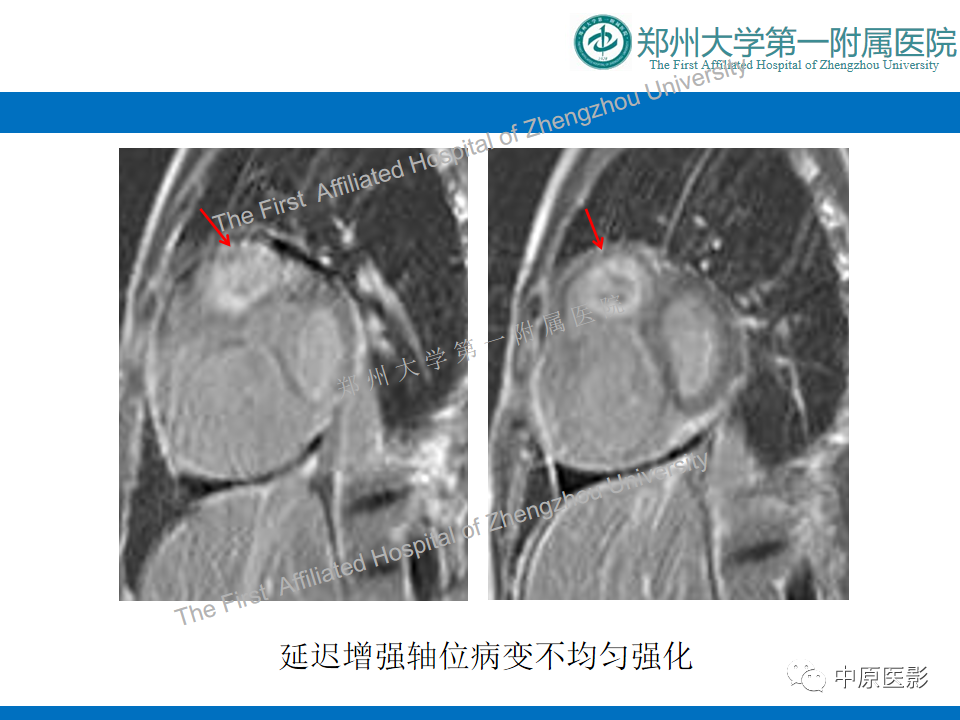 影像PPT - 【病例】心脏血管瘤1例MR影像-6