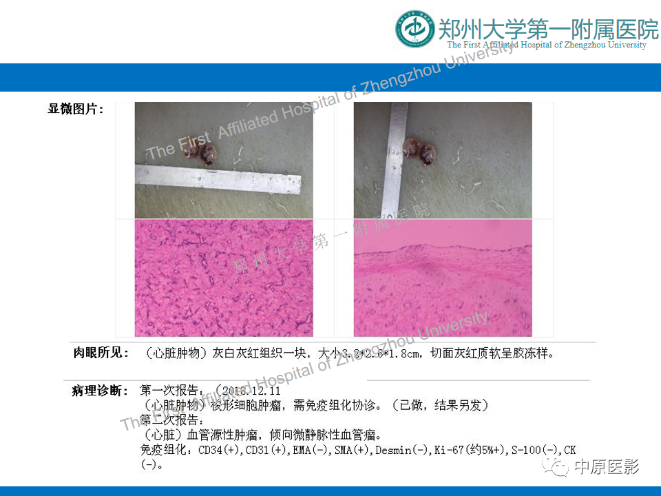 影像PPT - 【病例】心脏血管瘤1例MR影像-8