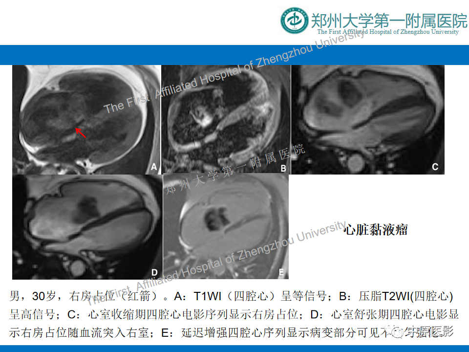 影像PPT - 【病例】心脏血管瘤1例MR影像-12