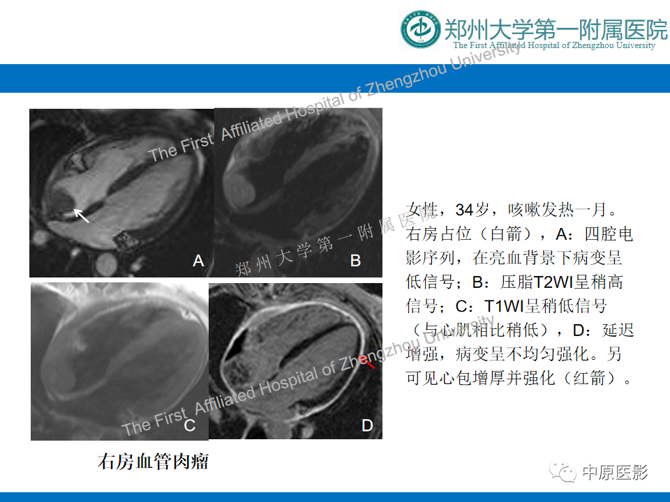影像PPT - 【病例】心脏血管瘤1例MR影像-14