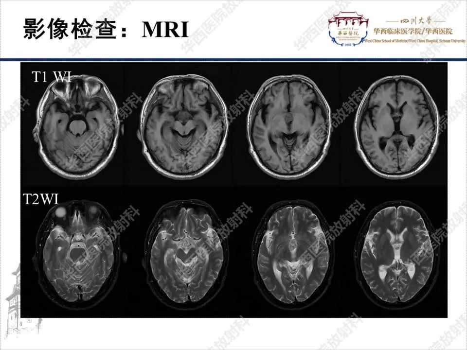 影像PPT - 【PPT】颅咽管瘤1例MR影像鉴别诊断-4