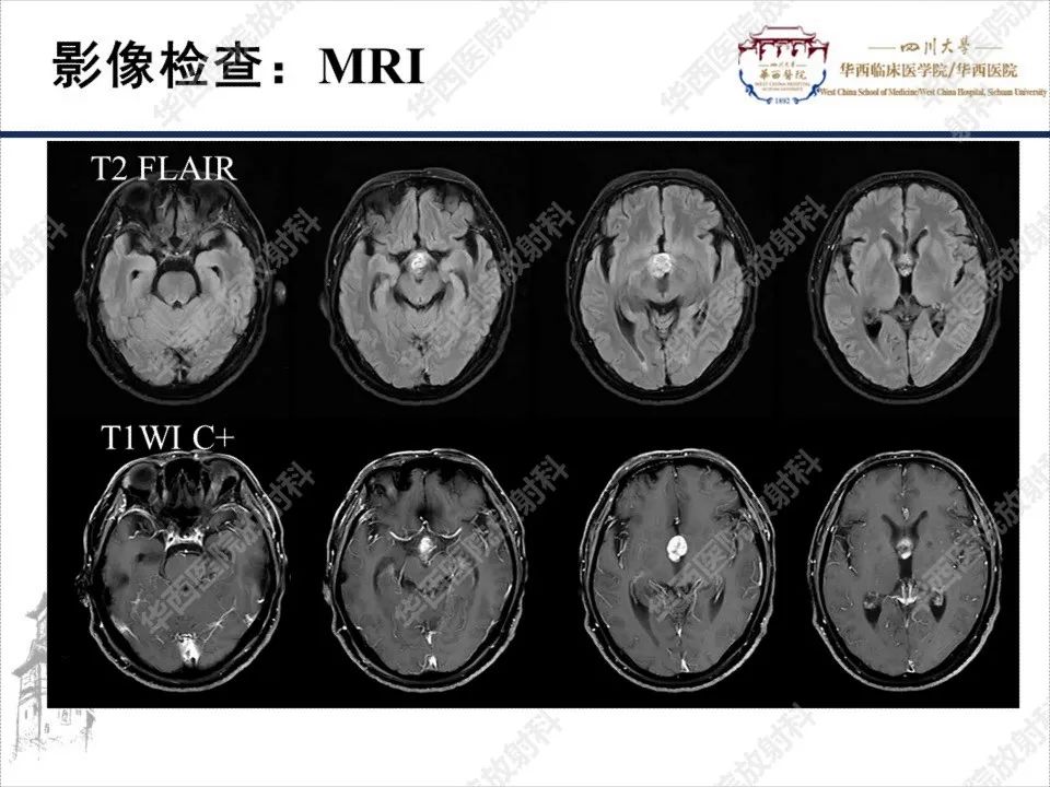 影像PPT - 【PPT】颅咽管瘤1例MR影像鉴别诊断-5