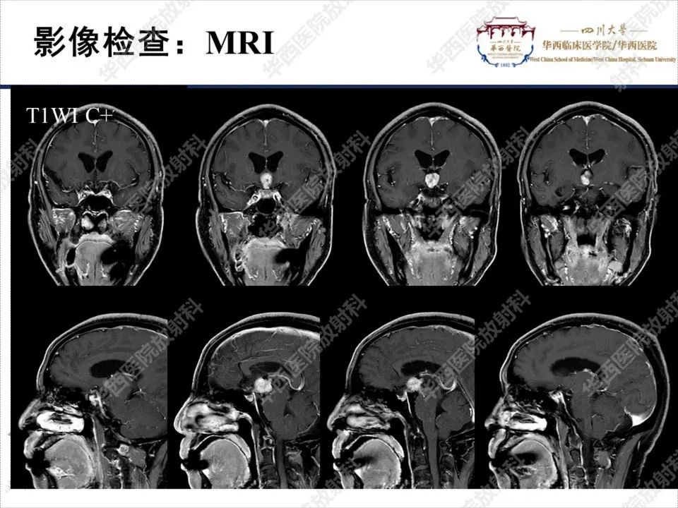 影像PPT - 【PPT】颅咽管瘤1例MR影像鉴别诊断-6