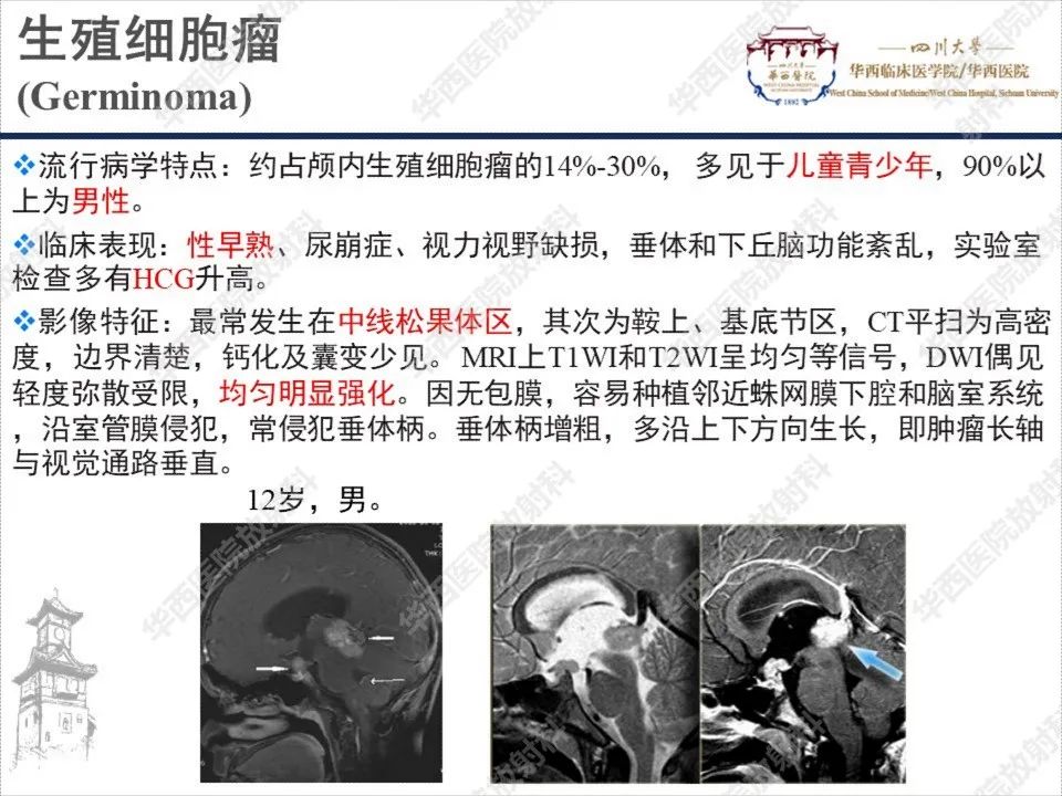 影像PPT - 【PPT】颅咽管瘤1例MR影像鉴别诊断-13
