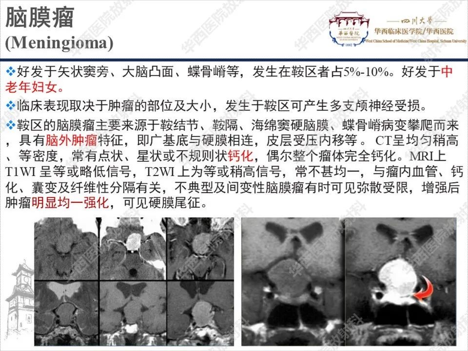 影像PPT - 【PPT】颅咽管瘤1例MR影像鉴别诊断-16