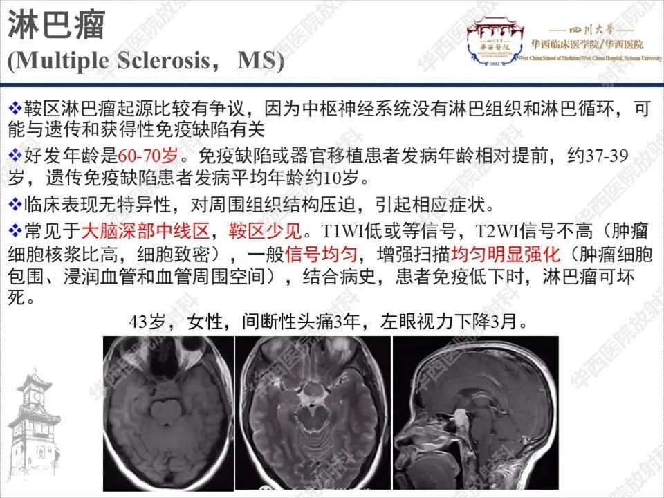 影像PPT - 【PPT】颅咽管瘤1例MR影像鉴别诊断-17