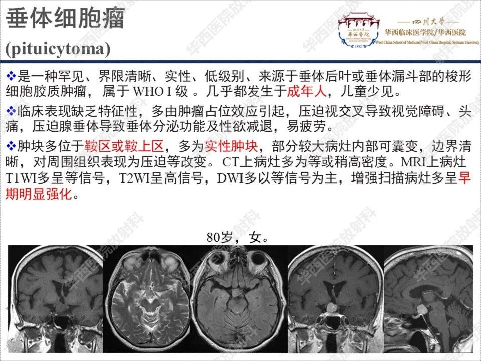 影像PPT - 【PPT】颅咽管瘤1例MR影像鉴别诊断-20