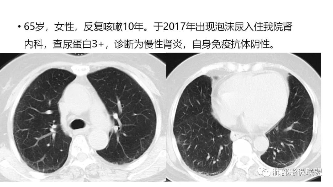 影像PPT - 【PPT】肺粘液腺癌—一种疾病,两种表现-2 影像PPT - 【PPT】肺粘液腺癌—一种疾病,两种表现-2