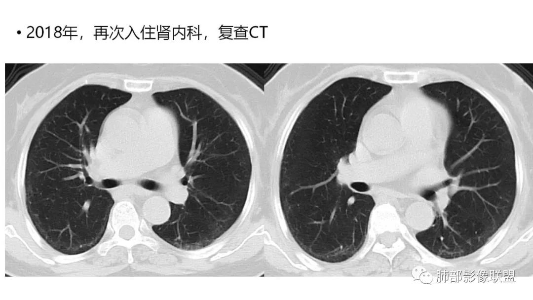 影像PPT - 【PPT】肺粘液腺癌—一种疾病,两种表现-4 影像PPT - 【PPT】肺粘液腺癌—一种疾病,两种表现-4