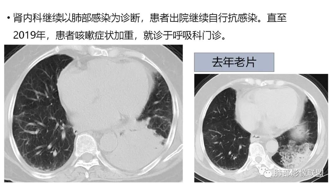 影像PPT - 【PPT】肺粘液腺癌—一种疾病,两种表现-6 影像PPT - 【PPT】肺粘液腺癌—一种疾病,两种表现-6