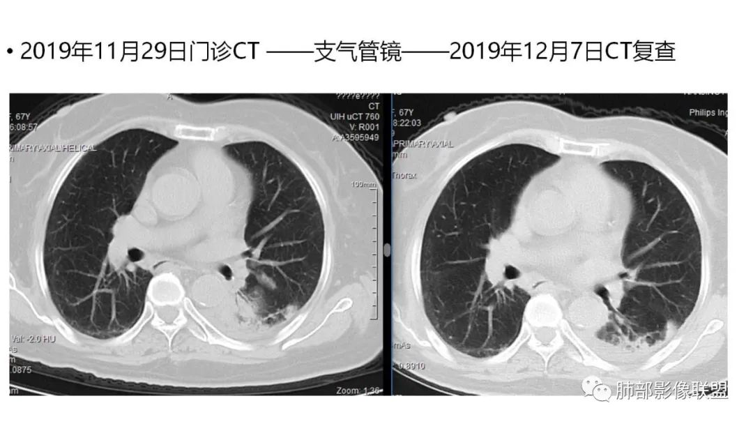 影像PPT - 【PPT】肺粘液腺癌—一种疾病,两种表现-8 影像PPT - 【PPT】肺粘液腺癌—一种疾病,两种表现-8