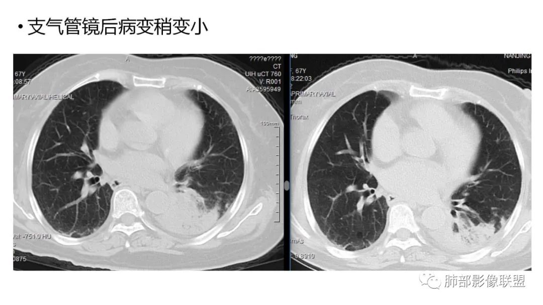 影像PPT - 【PPT】肺粘液腺癌—一种疾病,两种表现-9 影像PPT - 【PPT】肺粘液腺癌—一种疾病,两种表现-9