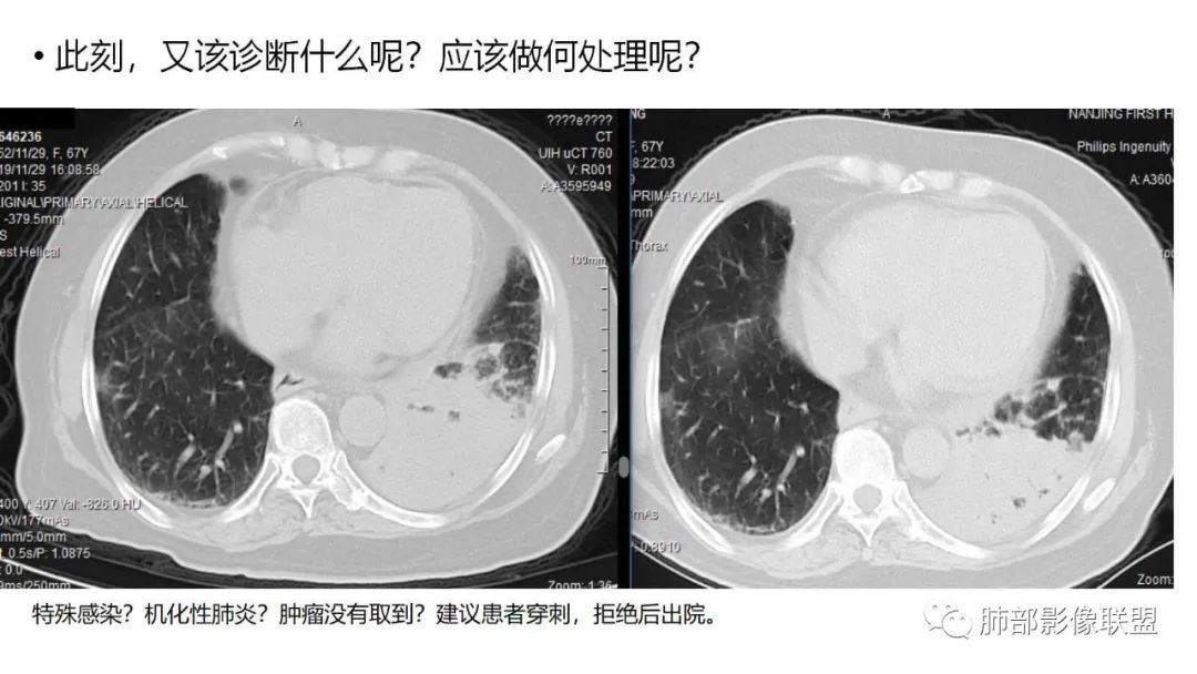 影像PPT - 【PPT】肺粘液腺癌—一种疾病,两种表现-10 影像PPT - 【PPT】肺粘液腺癌—一种疾病,两种表现-10