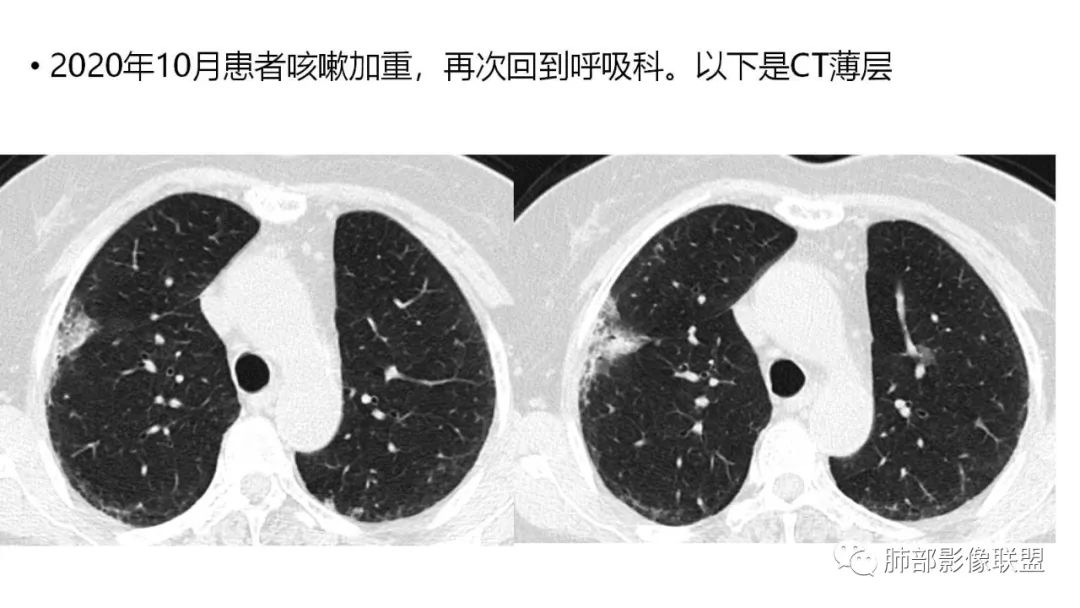 影像PPT - 【PPT】肺粘液腺癌—一种疾病,两种表现-11 影像PPT - 【PPT】肺粘液腺癌—一种疾病,两种表现-11