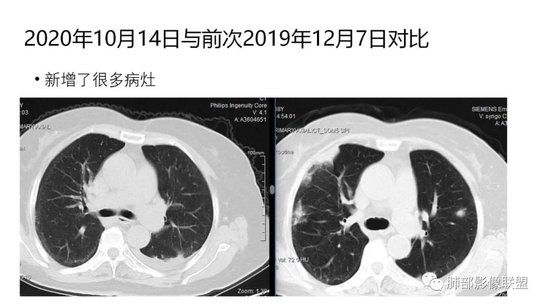 影像PPT - 【PPT】肺粘液腺癌—一种疾病,两种表现-25 影像PPT - 【PPT】肺粘液腺癌—一种疾病,两种表现-25