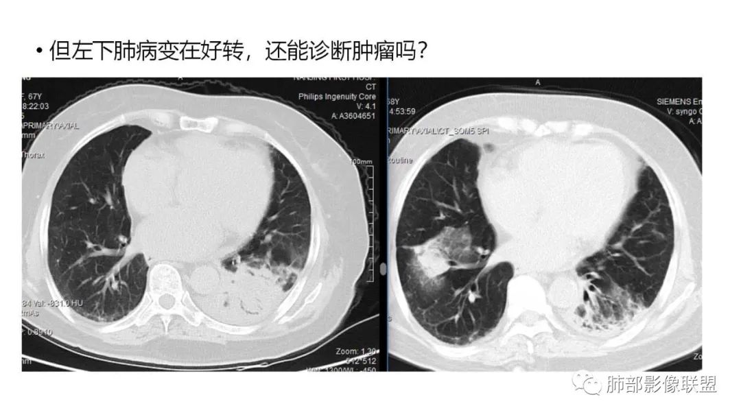 影像PPT - 【PPT】肺粘液腺癌—一种疾病,两种表现-26 影像PPT - 【PPT】肺粘液腺癌—一种疾病,两种表现-26