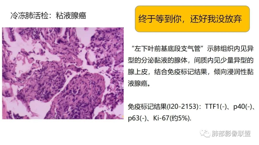 影像PPT - 【PPT】肺粘液腺癌—一种疾病,两种表现-28 影像PPT - 【PPT】肺粘液腺癌—一种疾病,两种表现-28
