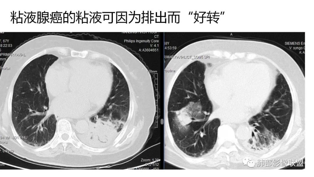 影像PPT - 【PPT】肺粘液腺癌—一种疾病,两种表现-30 影像PPT - 【PPT】肺粘液腺癌—一种疾病,两种表现-30