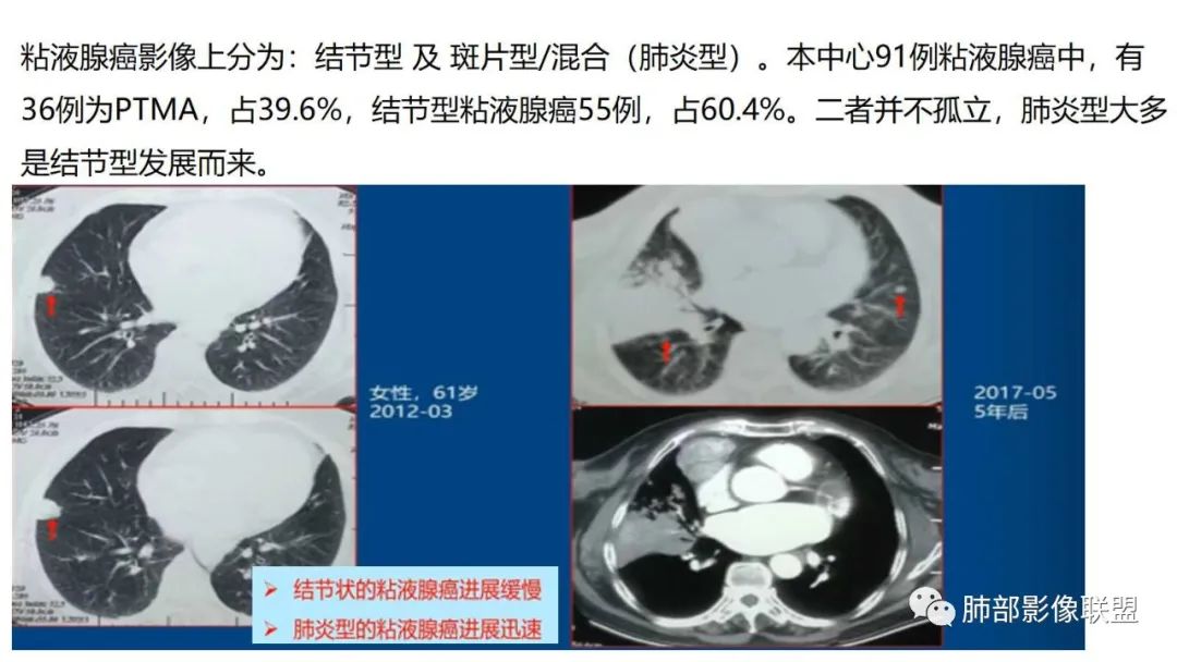 影像PPT - 【PPT】肺粘液腺癌—一种疾病,两种表现-32 影像PPT - 【PPT】肺粘液腺癌—一种疾病,两种表现-32