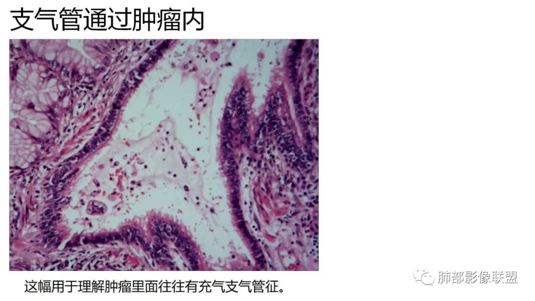 影像PPT - 【PPT】肺粘液腺癌—一种疾病,两种表现-42 影像PPT - 【PPT】肺粘液腺癌—一种疾病,两种表现-42