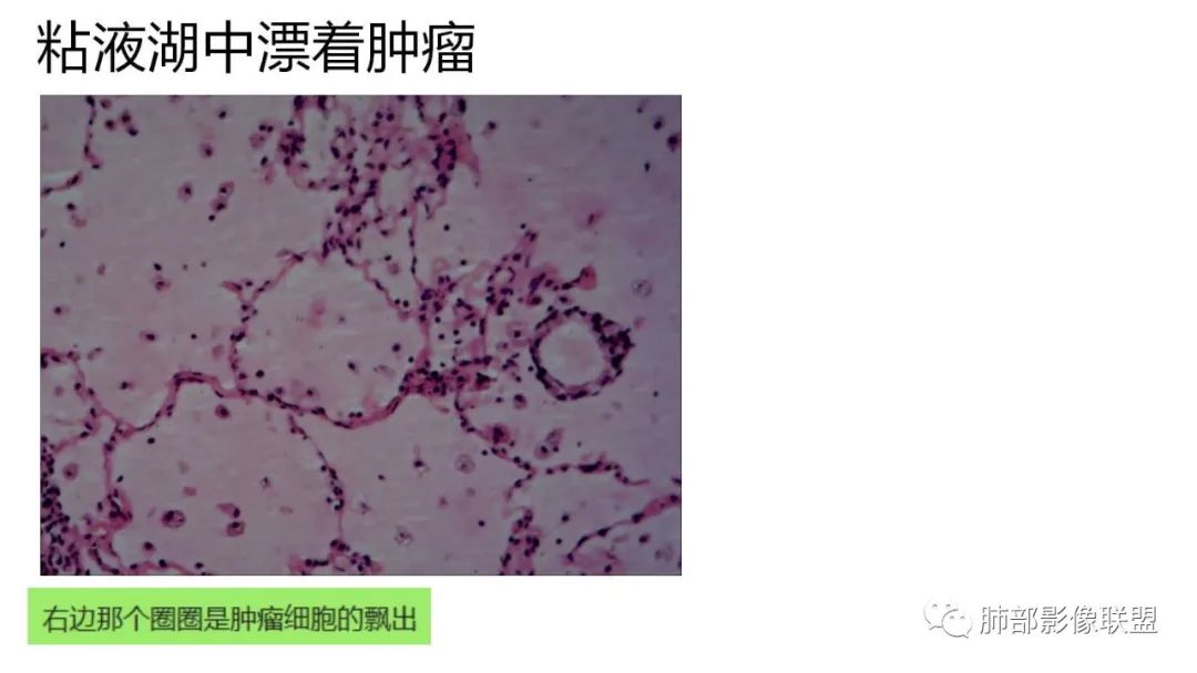 影像PPT - 【PPT】肺粘液腺癌—一种疾病,两种表现-43 影像PPT - 【PPT】肺粘液腺癌—一种疾病,两种表现-43