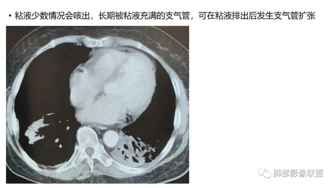 影像PPT - 【PPT】肺粘液腺癌—一种疾病,两种表现-48 影像PPT - 【PPT】肺粘液腺癌—一种疾病,两种表现-48