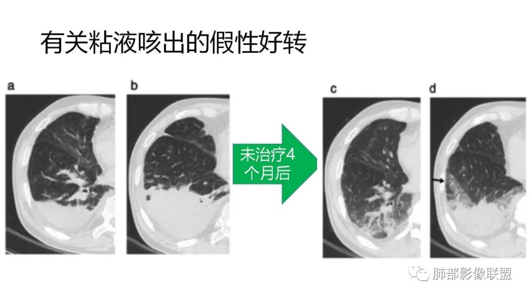 影像PPT - 【PPT】肺粘液腺癌—一种疾病,两种表现-49 影像PPT - 【PPT】肺粘液腺癌—一种疾病,两种表现-49