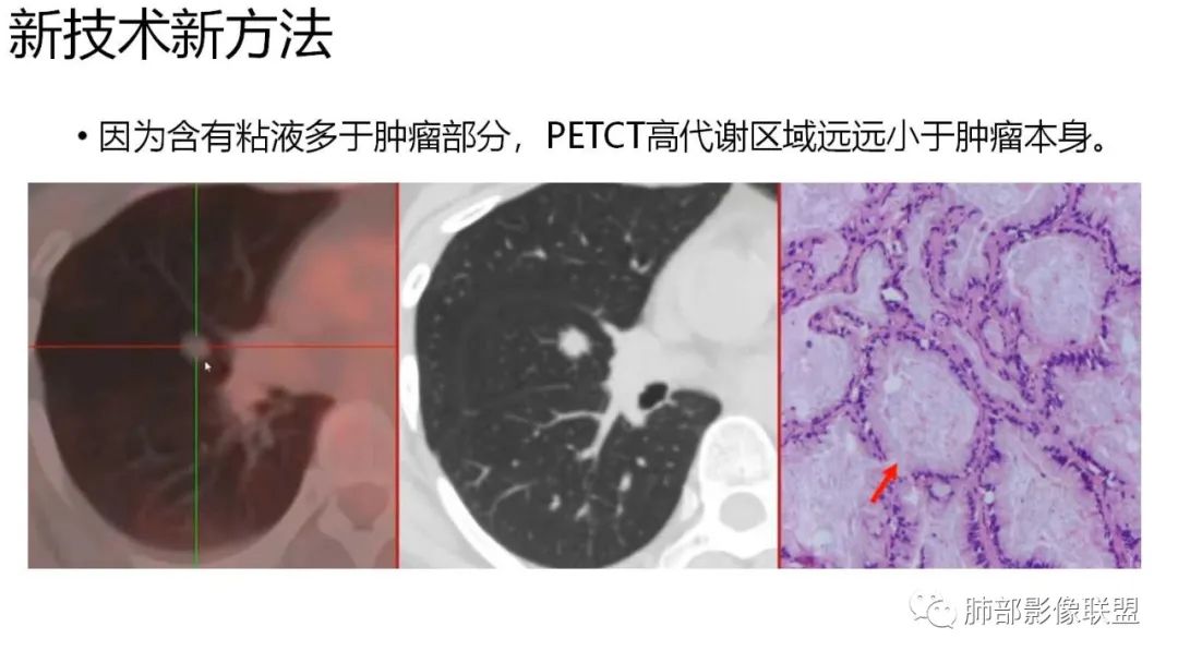 影像PPT - 【PPT】肺粘液腺癌—一种疾病,两种表现-50 影像PPT - 【PPT】肺粘液腺癌—一种疾病,两种表现-50