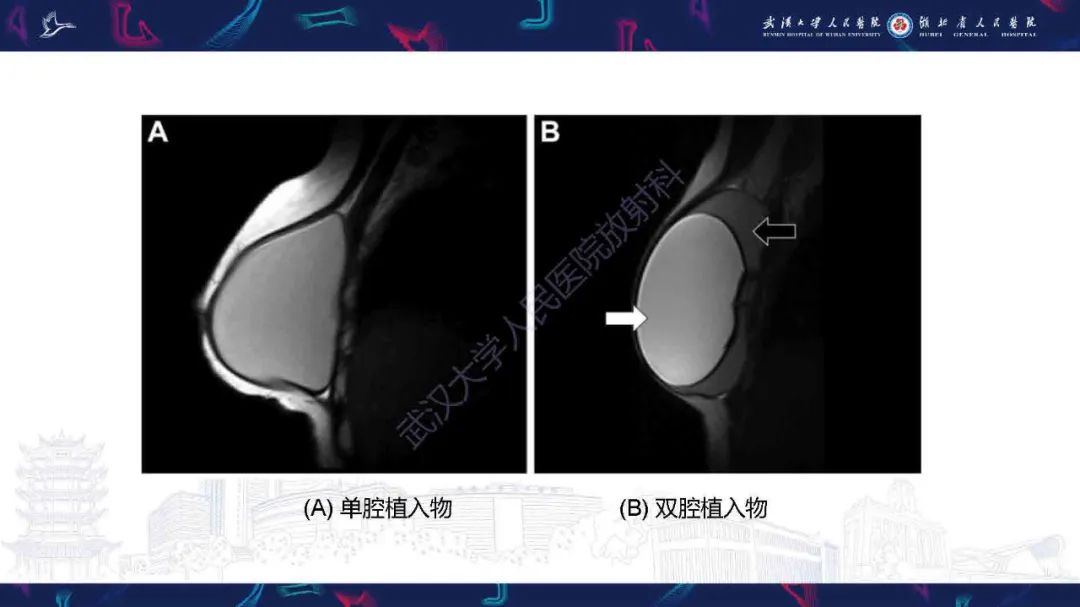 影像PPT - 【PPT】隆胸术后并发症MRI诊断-5