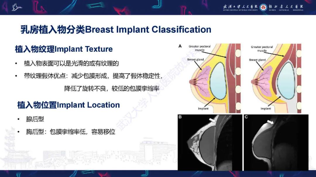 影像PPT - 【PPT】隆胸术后并发症MRI诊断-6