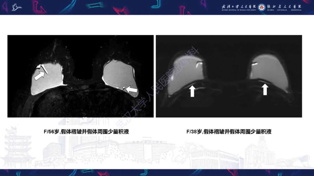 影像PPT - 【PPT】隆胸术后并发症MRI诊断-11